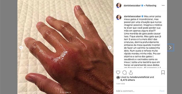 Estado que a mão da atriz ficou após a mordida, ela compartilhou em suas redes sociais tudo que aconteceu e nos mínimos detalhes (Foto Reprodução/Instagram)