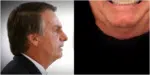 Jair Bolsonaro se submeteu a procedimento estético (Foto: Reprodução, Montagem, Fatos da TV)