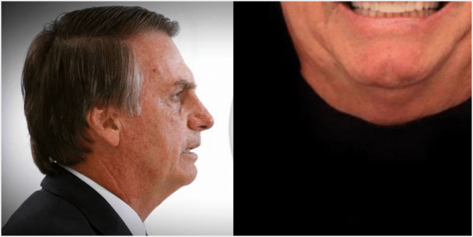 Jair Bolsonaro se submeteu a procedimento estético (Foto: Reprodução, Montagem, Fatos da TV)
